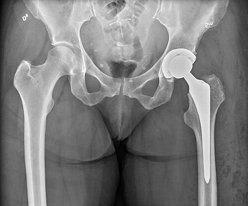 total hip arthroplasty